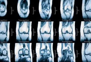 lesiones de menisco de la rodilla